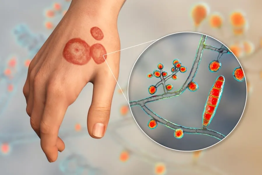 Drug-Resistant Ringworm Fungus Rapidly Spreads Across 29 Nations
